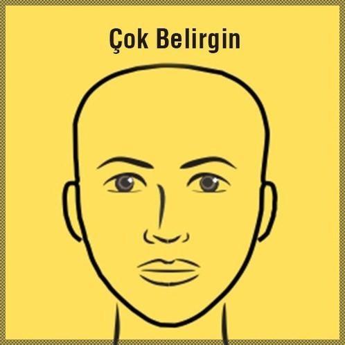 Çok belirgin alın:<br>    Hayal gücünün çok yoğun olduğunu gösterir.