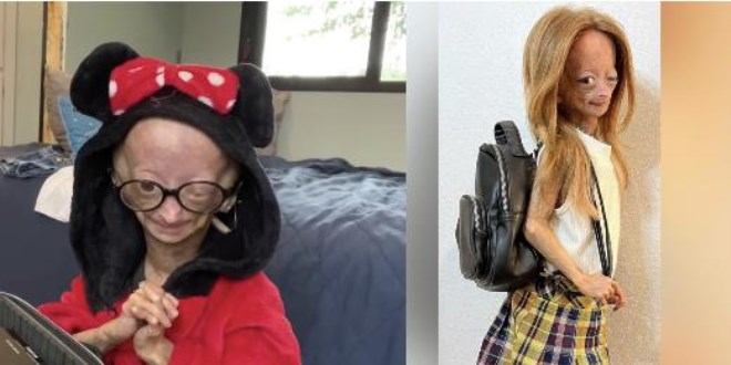 Bejamin Button hastalığıyla mücadele eden YouTuber hayatını kaybetti