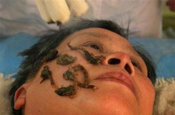 Çin'de ölü akrepler kullanılarak uygulanan tedavi.