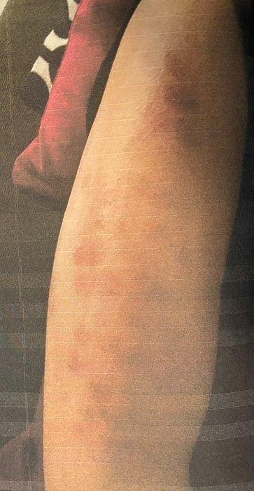 Lazer seanslarına devam eden kardeşler ilerleyen zamanlarda vücutlarında mor lekeler ve ikinci derece yanık izleri olduğunu gördü.