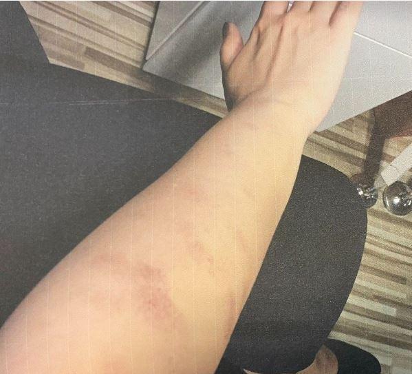 Güzellik merkezinden şikayetçi olan kardeşler konuyu mahkemeye taşıdı. Güzellik merkezi iddiaları reddetse de kız kardeşlerin aldığı raporda vücutlarında ikinci dereceden yanıklar oluştuğu belirlendi.