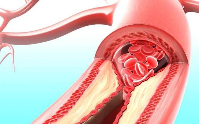 Osman Müftüoğlu'nun yazısı şöyle;    Hatırlayalım: Geçtiğimiz yıllarda rahmetli Deniz Baykal?ı,bu hastalık nedeniyle kaybettik.  Şimdi de kıymetli sanatçımız Kadir İnanır?ın gördüğü tedavi nedeniyle bize kendini yeniden -maalesef- hatırlattı ve adeta ?Ben buradayım, dikkatli ve tedbirli olun? mesajı verdi. Peki, nedir, neden olur, belirtileri, sonuçları nelerdir ve nasıl önlenir bu sağlık problemi? İşte o önemli soruların yanıtları...