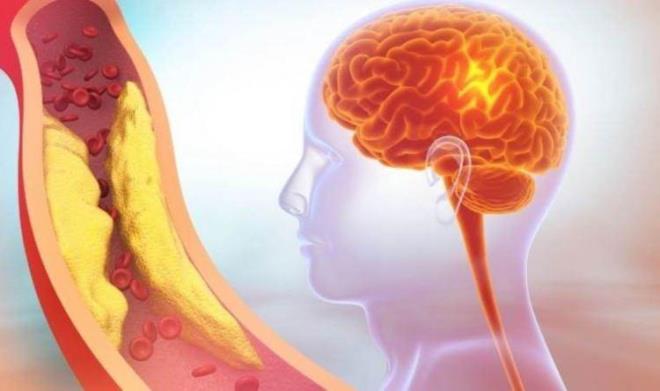 Sağlıklı yaşayan, genetik risklerini iyi yöneten sağlığını dikkatle izleyen ve gerekli tedbirleri zamanında alan, beslenmesine, uykusuna, egzersizine dikkat eden, sağlık problemlerinin çözümüne özen gösteren kişilerde şahdamarları kolay kolay sertleşmez, plak yapmaz ve tıkanmaz. Şahdamarlarını tıkayan temel nedenleri önem sıralarına göre alttaki sorunun yanıtında bulabilirsiniz.