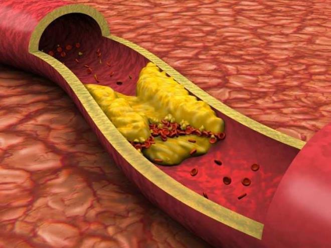 KİMLERİN ŞAHDAMARI DAHA KOLAY TIKANIR