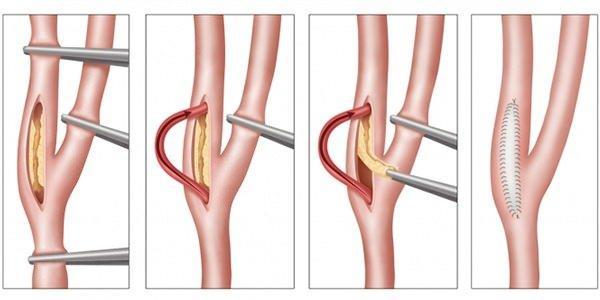 Karotis damarları/şahdamarlarımız boynumuzun her iki yanında yer alan ve kalpten gelen oksijen ve besin yüklü kanı baş ve beyin bölgesine ileten hayat borularımızdır. Ne var ki zaman içinde en çok da orta ve ileri yaşlarda bu damarların içinde ve duvarında damar sertliği/ateroskleroza bağlı olarak duvar kalınlaşması ve sertleşmesi, plaklar/pıhtılar oluşmaya başlar. Sonuçta şah damarlarımızın iç duvarı daralır, beyin beslenemez ya da pıhtılardan kopan parçalar nedeniyle hasar görür.