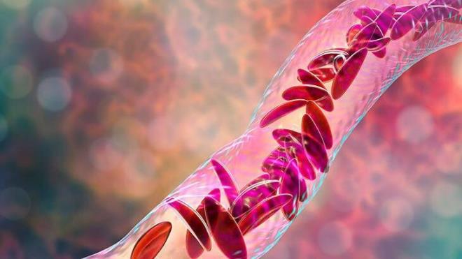 ŞAHDAMARINDAKİ O PLAKLAR NEDEN TEHLİKELİ    ŞAHDAMARLARINDA oluşan o plaklar/pıhtılar damarları ciddi oranda daraltarak beyne giden kan akışını engelleyebilir. Ayrıca plak oluşumu damar duvarının yapısını bozup deforme eder, tehlikeli ve kopmaya müsait kan pıhtılarının/yağlı ve kararsız kopmaya hazır parçacıkların oluşmasına yol açabilir. Plaklardan kopan bu pıhtılar/parçacıklar beyni besleyen daha küçük damarları ani olarak tıkadıklarında ise ortaya geçici veya kalıcı felç hali, bellek bozukluğu ve daha tehlikeli bazı sonuçlar ortaya çıkacaktır.