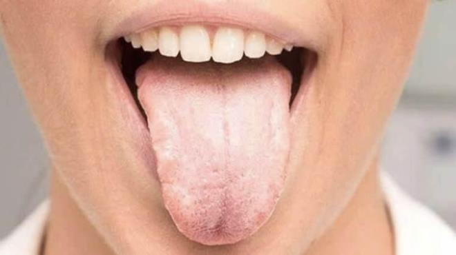 1. Soluk veya Beyaz Dil  <br>  Diliniz normalden daha soluk veya beyaz görünüyorsa, bu genellikle anemi, vitamin eksikliği ya da vücudun susuz kalmasıyla ilişkilendirilir.