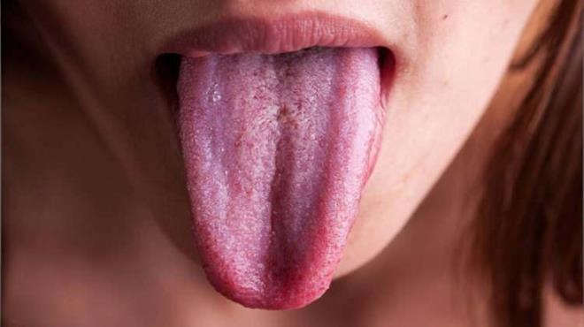 Bununla birlikte, sarı dil bazen mide ve karaciğer hastalıklarıyla ilişkilendirilebilir. Özellikle safra yolları tıkanıklığı veya hepatit gibi durumlar dilin sarılaşmasına yol açabilir.Bununla birlikte, sarı dil bazen mide ve karaciğer hastalıklarıyla ilişkilendirilebilir. Özellikle safra yolları tıkanıklığı veya hepatit gibi durumlar dilin sarılaşmasına yol açabilir.