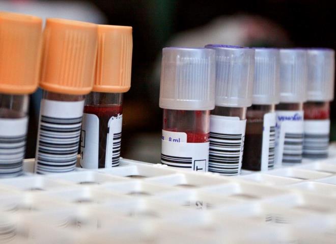 Bilim dergisi Neurology'de yayımlanan bir araştırma sonucuna göre, kan grubu ile bunama riski arasında şaşırtıcı bir bağlantı söz konusu.