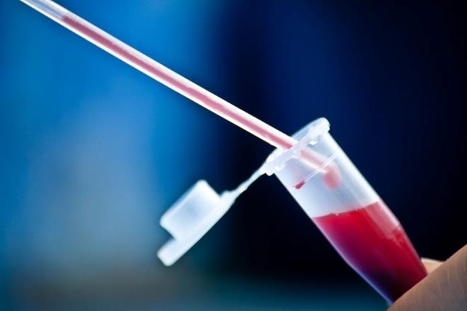 Vermont Üniversitesi Tıp Fakültesi'nden araştırmacıların katkılarıyla, Neurology dergisinde yayınlanan araştırmaya göre AB kan grubuna sahip kişilerin, diğer kan grubuna sahip kişilere göre bunama ( düşünme ve hafıza sorunları geliştirme) hastalığına yakalanma olasılığı yüzde 82 daha fazla.