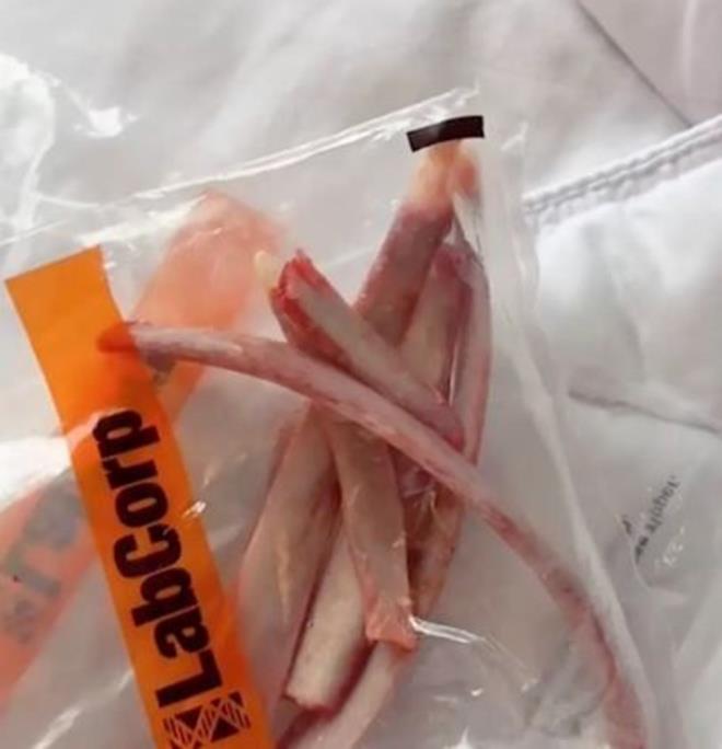 Kaburgalarının çıkarılmasının ardından James, başlangıçta bu kemikleri en yakın arkadaşı için saklamayı düşündü ancak daha sonra ''Galiba kaburgaların bende kalması daha anlamlı'' dedi.