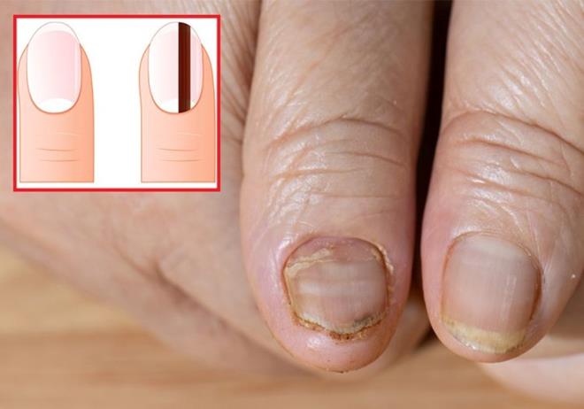 Tırnaklarınızın üzerinde gördüğünüz ancak önemsemediğiniz basit çizgiler sağlığınızla ilgili sinyal veriyor olabilir. Tırnakta oluşan bazı lekeler cilt kanserinin habercisi olabilir. Eğer tırnağınızda koyu renkli dikey bir çizgi varsa vakit kaybetmeden bir uzmana danışmanızda fayda var.