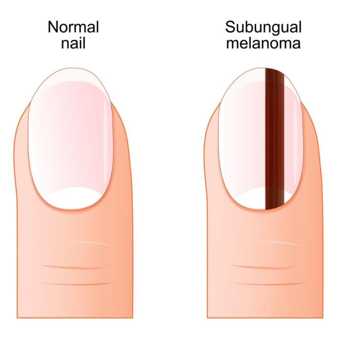 Tırnaklarda yapısal değişiklikler ciddi sağlık sorunlarının habercisi olabilir. Tırnak yapısının kalınlaşması, tırnak yatağından kalkması ya da tırnağın ortadan ikiye ayrılması bu belirtiler arasında yer alıyor. Ayrıca, koyu renkli çizgilerin tırnağın dışına doğru ilerleyerek çevredeki deriyi renklendirmesi de nadir görülen bir durum. Bu durum, her 30 vakadan birinde ortaya çıkıyor.    Tırnak melanomu hayatı tehdit eden en ciddi tırnak hastalığıdır. Tırnak melanomlarının büyük çoğunluğu tırnakta uzunlamasına yerleşen kahverengi-siyah bir çizgi, bant şeklinde başlar. Tırnak melanomları daha az oranda kahverengi-siyah renk değişikliği olmaksızın pembe, kırmızı renk değişikliği şeklinde de ortaya çıkabilir. Hastalığın kesin tanısı için mutlaka tırnak altında yerleşen hastalıklı alandan biyopsi alınarak patolojik inceleme yapılması gereklidir.