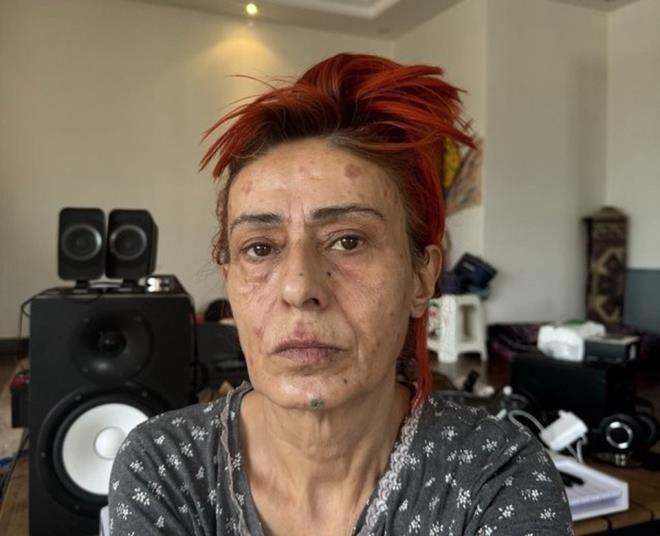 "GEÇER İNŞALLAH"<p>    Takipçilerinin "geçmiş olsun" mesajlarına da yanıt veren 58 yaşındaki Tilbe, "Doktora gittim, krem-hap verdiği her şeyi uyguluyorum. Geçer inşallah, çok sağ olsun" dedi.