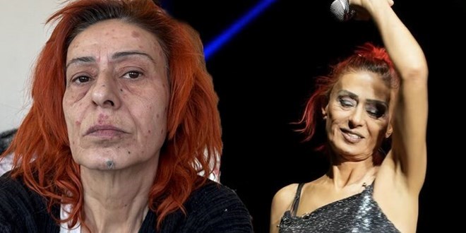 Yıldız Tilbe'nin yüzünde yanıklar meydana geldi: Son halini paylaştı