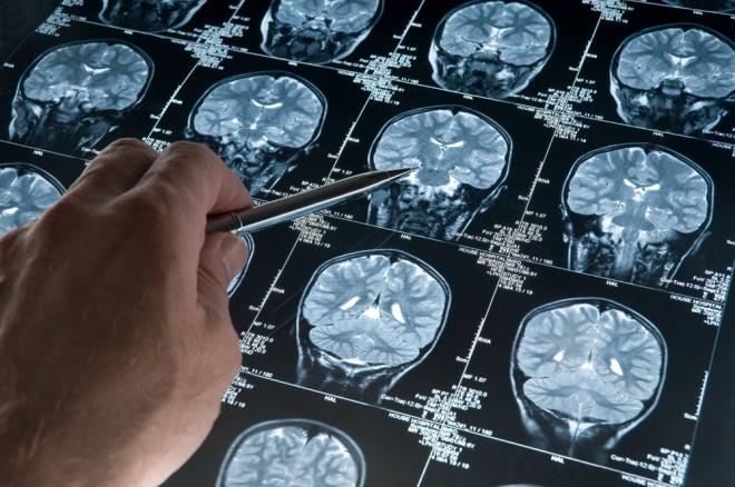 Uzun zamandır Alzheimer?ın kadınlarda daha yaygın görüldüğü düşünülüyordu. Ancak güncel bir araştırma, babası Alzheimer hastası olan çocukların, beyinde tau adlı toksik bir proteinin yayılmasına daha yatkın olduklarını belirledi.