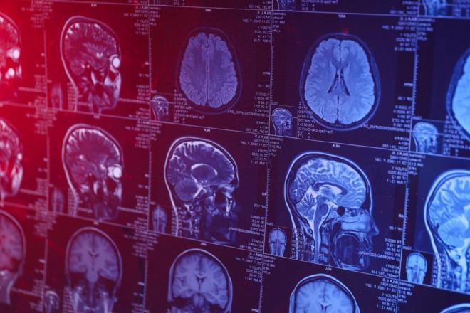 Çalışmada, ailelerinde Alzheimer öyküsü bulunan ancak kendilerinde herhangi bir hafıza veya düşünme sorunu olmayan, yaşları ortalama 68 olan 243 kişi incelendi.     Katılımcılara beyin taramaları ve hafıza ile düşünme testleri uygulandı. Yedi yıllık takip sonucunda, 71 katılımcıda Alzheimer hastalığının erken belirtisi olan hafif bilişsel bozukluk tespit edildi.