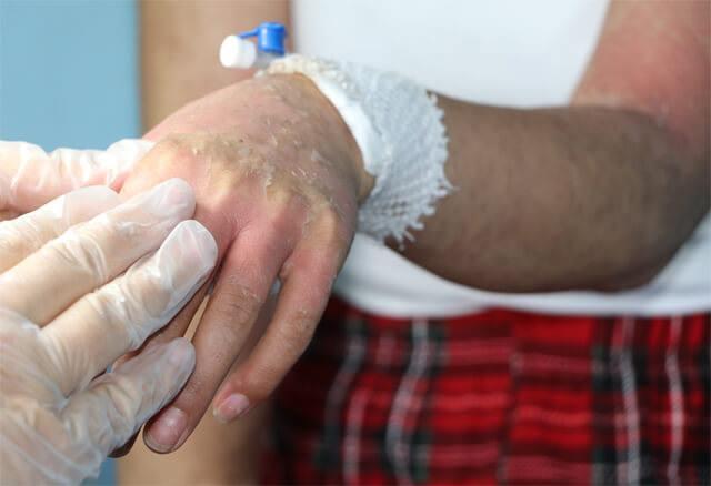 D.K.?nin tedavi sürecinde yüksek doz kortizon ve bağışıklık baskılayıcı ilaçlar kullanıldığını da ekleyen Prof. Dr. Özkol, ?İnternetten veya sosyal medyadan menşei belli olmayan, dermatolog onayı olmayan cilt beyazlatıcı veya leke giderici kremler kullanılmamalı. Aksi halde ağır yanıklar ve kalıcı izler kalabilir.  Bir leke uğruna hayatınızı riske atmayın.? diye bir kere daha uyarısını yeniledi.