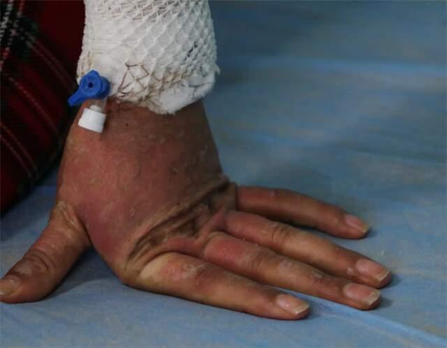 Dermatoloji Uzmanı Prof. Dr. Hatice Uce Özkol, kremin içerisinde yoğun miktarda kojik asit bulunduğunu ve bunun ?kezzap gibi yüz yakıcı bir madde? olduğunu belirterek, hastanın yüzü ve vücudunda ciddi yanıklar oluştuğunu; nefes darlığı ve halsizlik gibi hayati tehlike boyutunda belirtiler gösterdiğini söyledi.