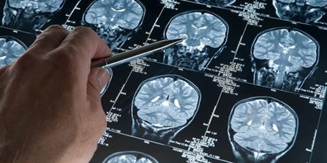Alzheimer vakaları neden arttı?