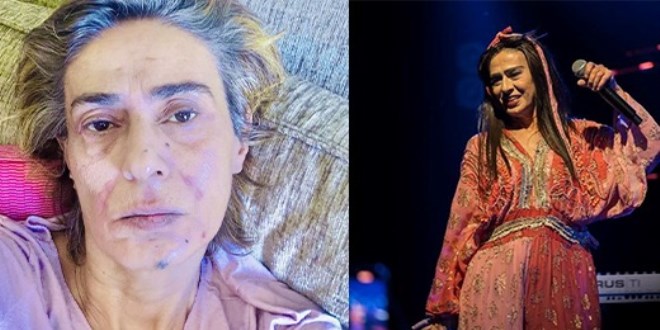 Yıldız Tilbe'den yeni paylaşım: Yüzünün hali endişelendirdi