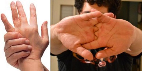 Parmakların çıtlamasının gerçek nedeni