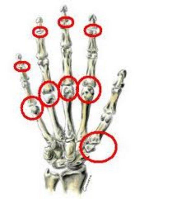 indeki svnn Basnc azalr ve Gaz kabarcklar patlamaya balar. te kulamza gelen bu seslerdir.