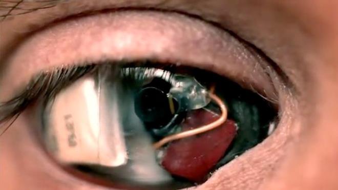 Rob Spence televizyon kanal iin mlakata gittiinde ekim ekibi olmakszn, gzndeki kamera yardm ile ekimleri gerekletiriyor.