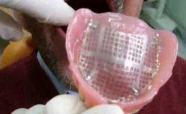 Takma diler ve azdaki yapsal bozukluklar iin kullanlan protez damaklar da bakteri yuvasdr.