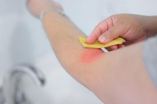 Yank aclarnz dindirin, kantlarnzdan kurtulun. Yank blgeyi souk su ile iyice ykadktan sonra muz kabuunun etli tarafn kullanarak yan sakinletirin ve tedavi edin.