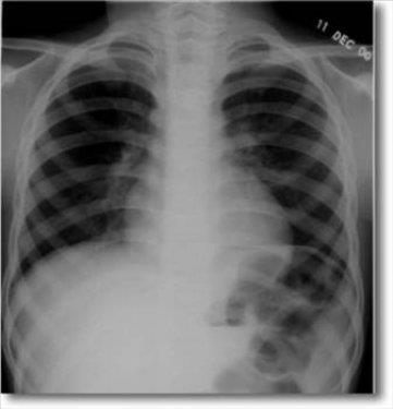 17 yandaki gen kzn karnndan karlan madeni nesnelerin arasnda jilet ve iviler de bulundu.