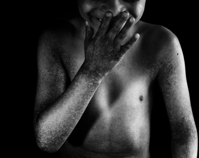 Hastalk tehisi 3 yanda konulan Alex&#8217;in korneasnda da lser bulunuyor.