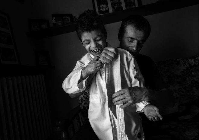 &#8220;Tek istediim normal ocuklar gibi gndzleri arkadalarmla oyun oynayabilmek&#8221; diyen Alex, ileri yalarda sadece kapal alanda glgeler iinde bir hayat srebilecek.