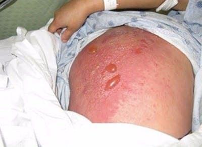 En ufak bir dokunula bile deri zerinde yanklar oluturacak kadar gl etkiye sahip.