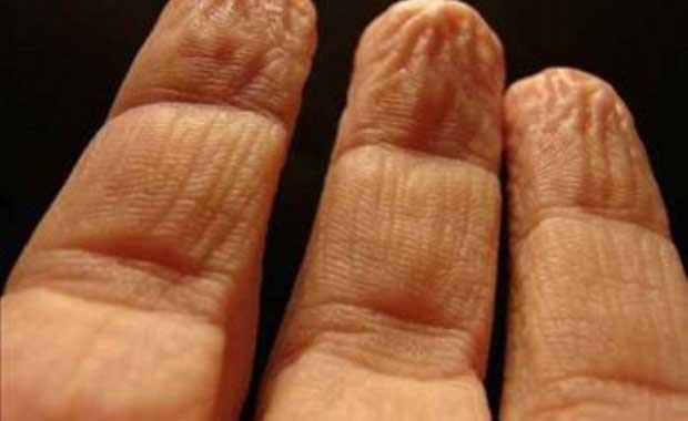 Kaybolan keratin tabakas sonucunda derimiz iine su almaktadr. Su alan deri ise ksa bir sre sonra burumaktadr.