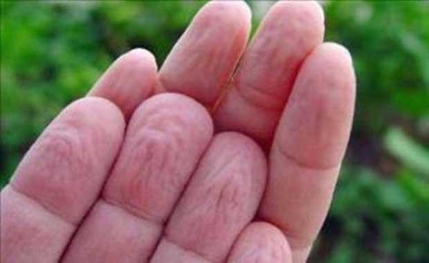 Ellerde aslnda bu burumay nleyen keratin tabakas bulunmaktadr. Ancak buralarn sk sk ykanmas sonucunda keratin tabaka giderek kaybolmaktadr.