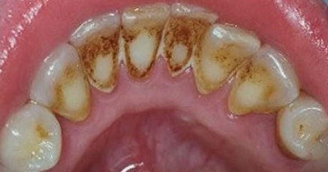 Bununla birlikte California niversitesi'nden Prof. Bruce Hammock, son bulgularn tketicilere verilen bilgileri deitireceini ve bu konuda tketicilerin daha da bilinlendirileceini ifade etti.