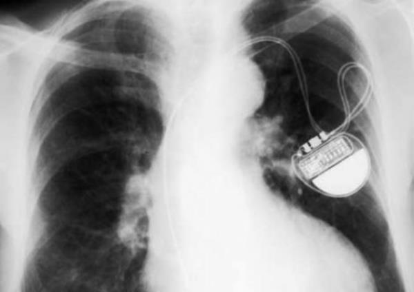 Kalp pili aslnda kalp seslerini kaydetmek iin retild