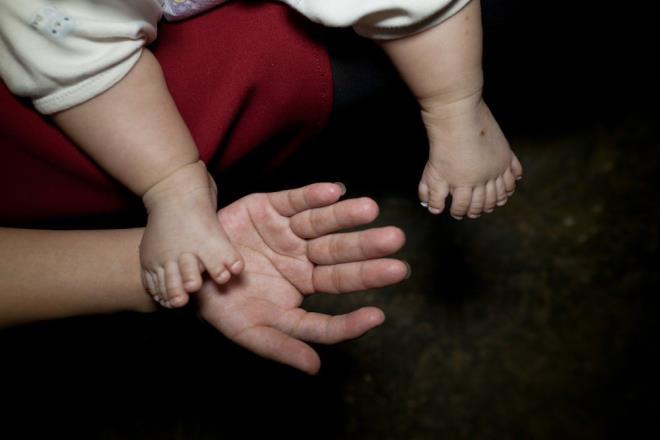 Doktorlardan yardm isteyen gen anne ise olu iin umudunu yitirmi durumda. Doktorlarn aklamalarna gre bu genetik bir anormallik, 6 yandan sonra ameliyat mmkn ama hem alnan sonu beklendii kadar yksek olmuyor hem de ok uzun ac verici ve pahal bir sre.