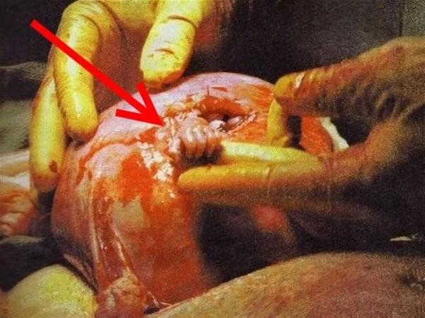 Bu fotoraf, anne karnnda 21 haftalk fetusa operasyon ile mdahale edilmesi srasnda, bebee mdahaleyi yapan doktorun elini tutarak kendisinden gven ve yardm bekleyiinin olaanst grnts olan yorumlanmt.