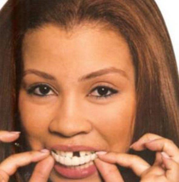 Di kusurlarn gidermek iin kullanlan bu uygulama iin kiinin az ve ene yaps bilgisayar yardmya belirleniyor. Sonra da kusurlarn giderecek bir misafirlik di hazrlanyor.