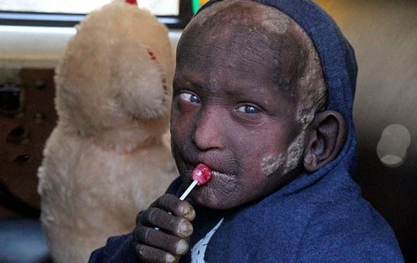 Ramesh'in cildinin kabuksu grn dier ocuklar dehete drd iin, kk ocuk akranlarndan uzak kalarak, 11 yana kadar hi arkada edinemeden hayatna devam etti. Uzun bir zaman hi tedavi umudu olmadn dnen anne Nar ve baba Nanda, aresizce oullarnn zaman iinde yavaa taa dnmesini izledi.