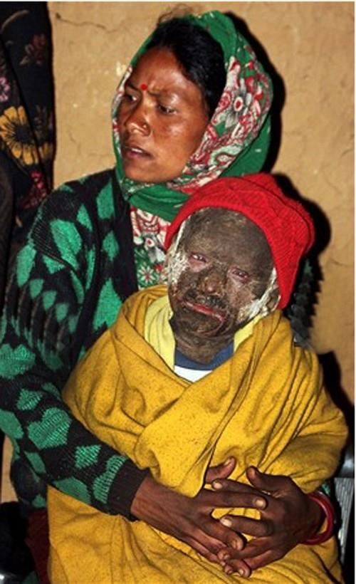 Ramesh 6 yana geldiinde rahatszl onu yryemez hale getirdi. Bundan dolay kk ocuk okula gidemedi. Baba Nanda (35) ve anne Nar (26) oullarnn ok nadir grlen, doutan gelen cilt hastalna yakalanm olduunun ve tedavi iin ellerinden bir ey gelmeyeceinin farkna vard.