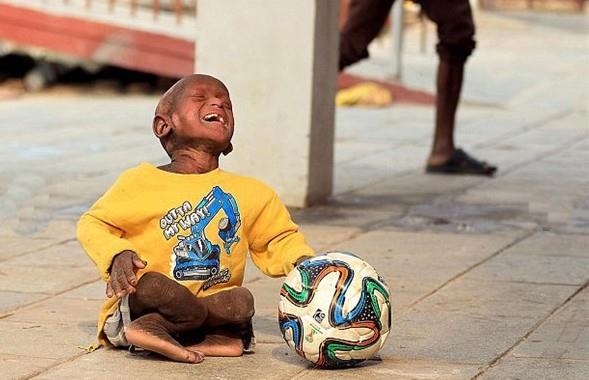 ngiliz kadn arkc Joss Stone'un ban ektii eitli ba organizasyonlar sayesinde 11 yandaki Ramesh, Kathmandu Salk niversitesi'nde tedavi altna alnd.