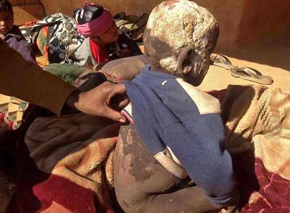 MailOnline'a konuan baba Nanda: "Olumun cildi doduktan 15 gn sonra soyulmaya balad. Yerine gelen yeni deri tabakas ok sert bir ekil ald. Zaman getike daha da sertleti ve siyaha dnd. Ne yapacamz hakknda hibir fikrimiz yoktu ve kimse bize yardm etmedi." szlerini sarf etti.