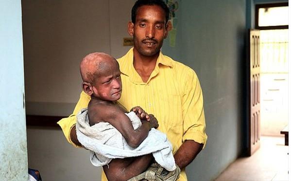 Sadece acktnda ya da tuvalet ihtiyac olduunda bizi haberdar edebildi. Otururdu ve alard fakat onun cann neyin yaktn ya da ona nasl yardm edebileceimizi bilemezdik. Onu gren btn kk ocuklar alaarak karlard. Bu yaananlar onun ve bizim iin katlanlmas ok zor bir durumdu."