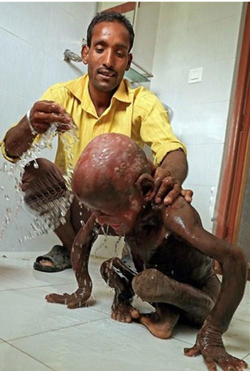 Aile'nin yaad, Nepal'in merkezine uzak bir blge olan Baglung'daki doktorlar, Ramesh'in kendilerini aknlk iinde brakan durumu karsnda 'mantar enfeksiyonu' tehisi koydular ve yardm edemeyeceklerini sylediler. Kk ocuun durumu gn getike daha ktye gitti.