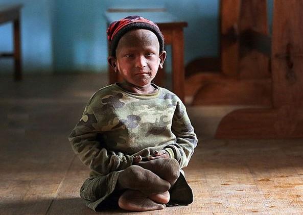 Kk Ramesh o gnden beri yavaa ve ok sancl bir ekilde kendi derisinin iinde dayanlmas g aclar ekiyor.