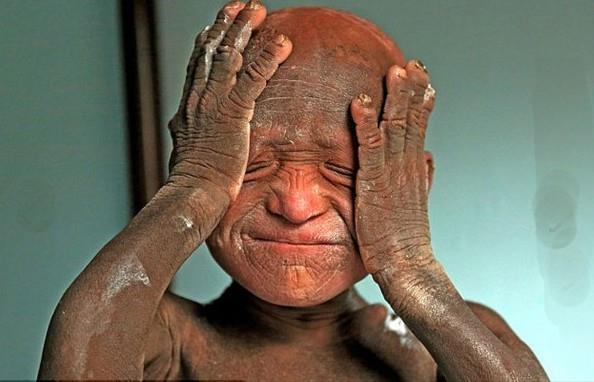 Nar Kumari yeni domu olunu ilk kez kucana aldnda dier bebeklerden hibir fark yoktu. Anne Kumari hastaneden eve geldikten 15 gn sonra, olu Ramesh'in cildi soyulmaya ve yerine kaln siyah bir deri tabakas olumaya balad.