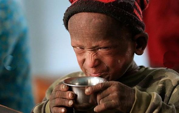 Ramesh nadir grlen cilt rahatszlndan tr yava yava tatan bir heykele dnyor. Rahatszlk kk ocuun yrmesine ve hatta konumasna mani oldu.